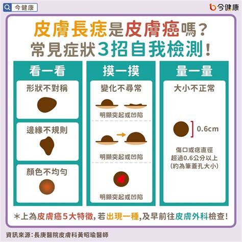 屁股長黑痣|皮膚長痣是皮膚癌嗎？常見症狀，簡單3招自我檢測｜元氣